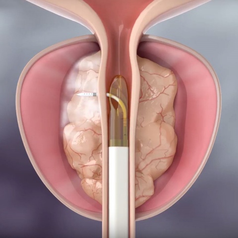 Bei der Rezum-Therapie wird Wasserdampf durch eine spezielle Sonde über die Harnröhre in das vergrößerte Prostatagewebe eingebracht. © Boston Scientific